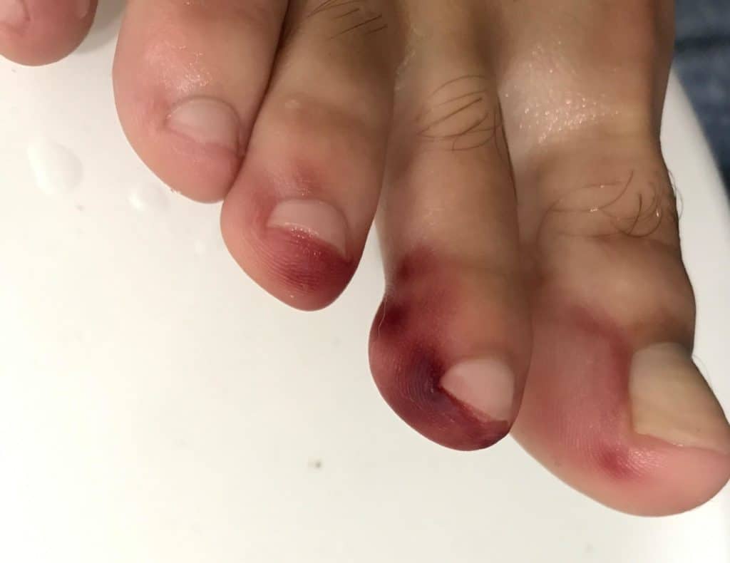 Close view of bruised and blackened toes after recieving a Millipede "burn"